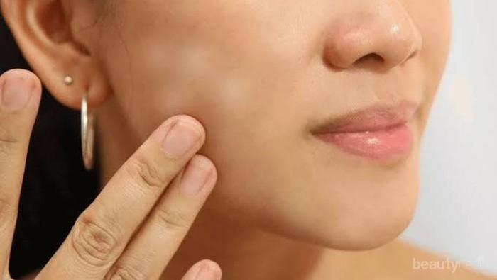 [FORUM] cara menghilangkan bercak putih/buras di muka gimana, gulrs?