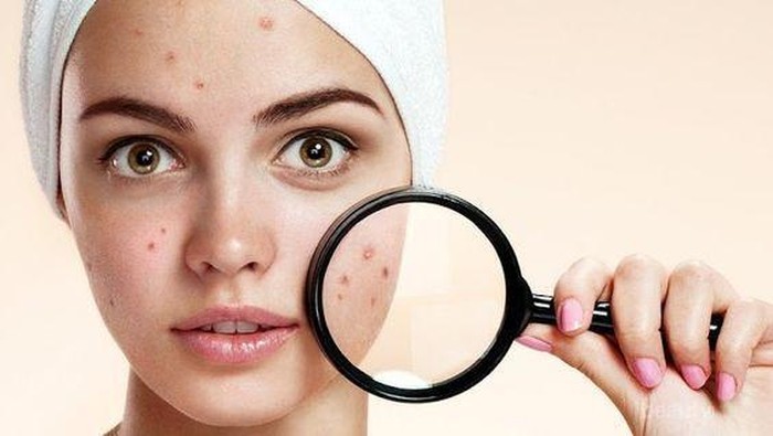 Mengenal dan Mengetahui Cara Atasi Jerawat Kistik