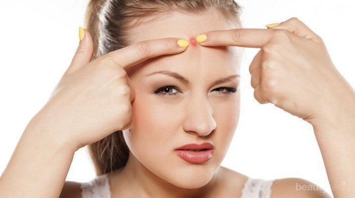 5 Fakta Penyebab Jerawat Datang Terus Tanpa 'Permisi'