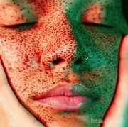 Kulit Berjerawat Bisa Jadi Kamu Terkena Fungal Acne, Apa Itu?