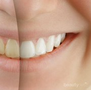 Ingin Putihkan Gigi, Lebih Baik Bleaching atau Veneer?