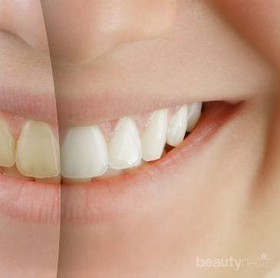 Ingin Putihkan Gigi, Lebih Baik Bleaching atau Veneer?