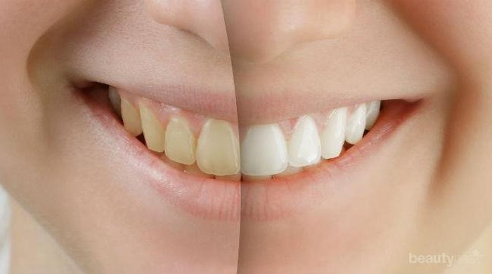 Ingin Putihkan Gigi, Lebih Baik Bleaching atau Veneer?