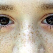 [FORUM] Bener ngga sih flek hitam hanya bisa dihilangkan pake laser?