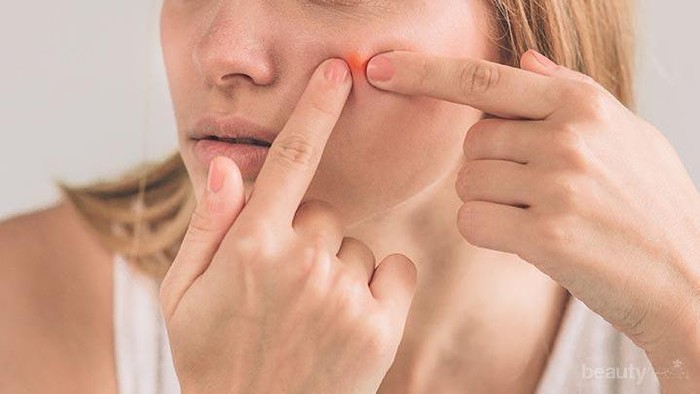 Beda Jenis Jerawat, Beda Juga Cara Penanganannya? Cari Tahu di Sini!