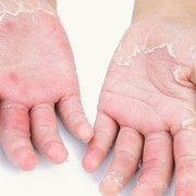 [FORUM] kulit tanganku suka tiba-tiba ngelupas, ada yang tau kenapa