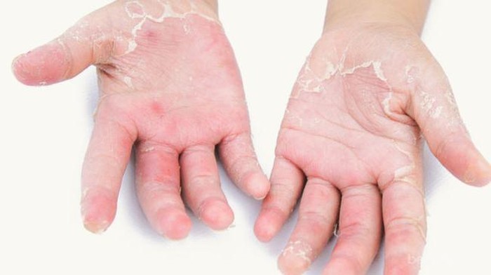 [FORUM] kulit tanganku suka tiba-tiba ngelupas, ada yang tau kenapa