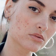 Skincare Routine Ini Cocok Buat Kamu yang Bermasalah dengan Jerawat, Terjangkau!