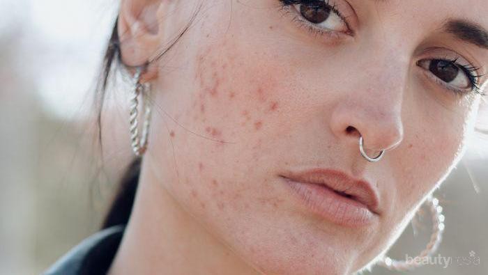 Skincare Routine Ini Cocok Buat Kamu yang Bermasalah dengan Jerawat, Terjangkau!