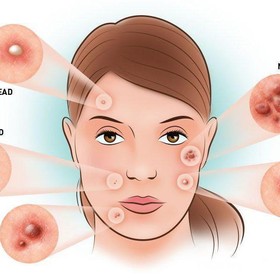[FORUM] Cara cepat buat menghilangkan bekas jerawat? Pake bahan alami apa ya?