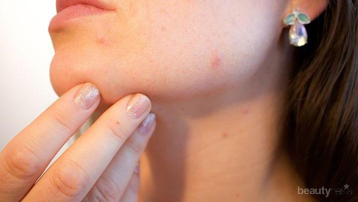 Kamu Harus Tahu, Alasan Wanita Dewasa Bisa Mengalami Breakout di Wajah!