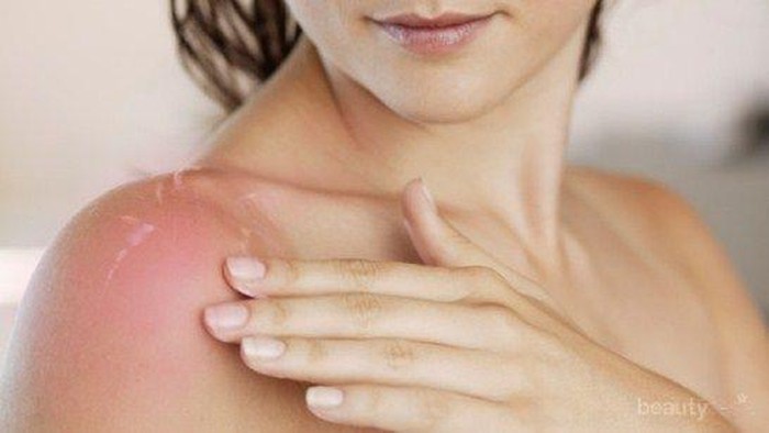 Mengapa Kulit Terasa Perih Setelah Terkena Matahari? Yuk Cari Tahu!