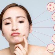 Muka Beruntusan? Sstt, Cara Ini Bisa Meredakan Beruntusan di Wajah Kamu!