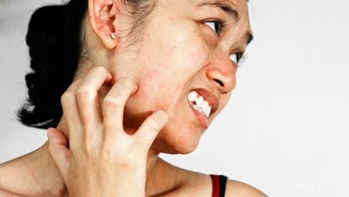 Kenali Penyebab dan Langkah Tepat Mengobati Alergi Pada Kulit Wajah!