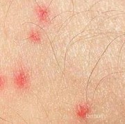 [FORUM] Cara hilangin bekas gigitan kutu gimana ya?