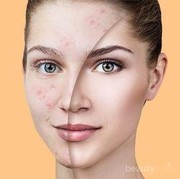 Sebel dengan Flek Hitam di Muka? Berikut Ini Cara Ampuh untuk Menghilangkannya, Ladies!