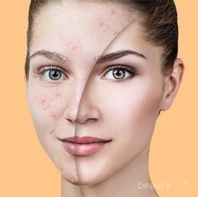 Sebel dengan Flek Hitam di Muka? Berikut Ini Cara Ampuh untuk Menghilangkannya, Ladies!