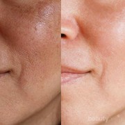 [FORUM] gimana sih buat ngecilin pori pori?