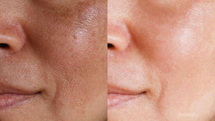 [FORUM] gimana sih buat ngecilin pori pori?