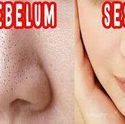 [FORUM] Apa cara yang paling ampuh untuk menghilangkan komedo?