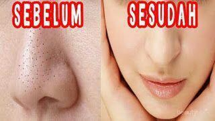 [FORUM] Apa cara yang paling ampuh untuk menghilangkan komedo?