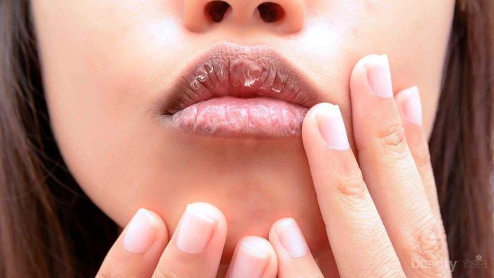 Biar Bibir Gak Kering, Ini 5 Hal yang Harus Kamu Lakukan Ladies