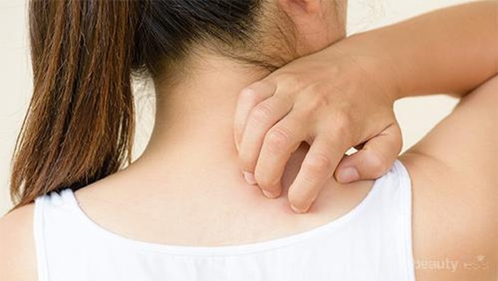 Nggak Pede Punya Jerawat Punggung? Ini Dia 6 Cara Mudah untuk Menghilangkannya, Ladies!