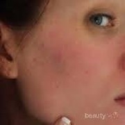 [FORUM] Wajah memerah akibat krim dokter