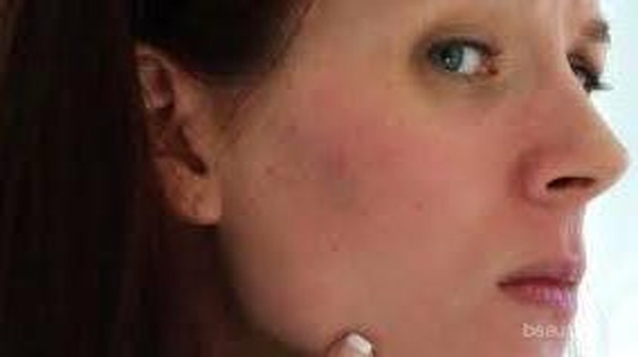 [FORUM] Wajah memerah akibat krim dokter