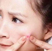 [FORUM] Cara cepat menghilangkan jerawat batu gimana ya beb?