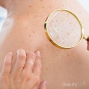 Jerawat di Punggung Pasti Bikin Risih, Coba Hilangkan dengan Cara Ini Yuk!