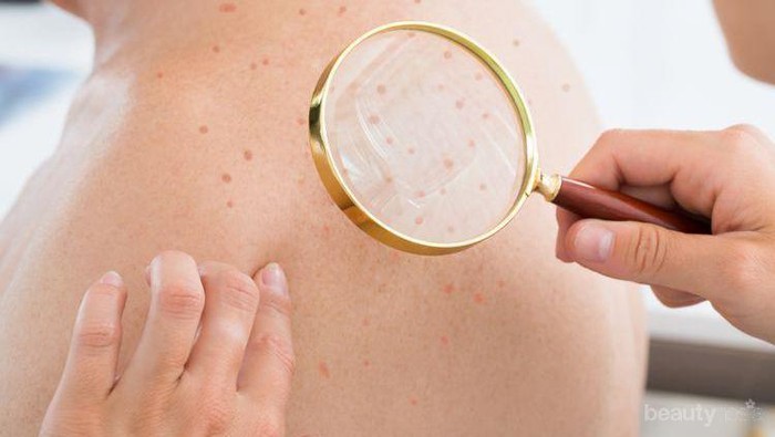 Jerawat di Punggung Pasti Bikin Risih, Coba Hilangkan dengan Cara Ini Yuk!