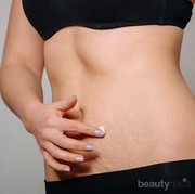 Stretch Marks Bikin Enggak Pede? Tenang, Tips Ini Dapat Menghilangkannya Sampai Tuntas!