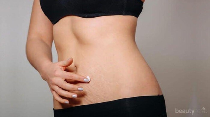 Stretch Marks Bikin Enggak Pede? Tenang, Tips Ini Dapat Menghilangkannya Sampai Tuntas!