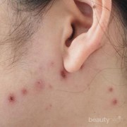 [FORUM] Ada yang tau gimana cara menghilangkan noda hitam bekas cacar??