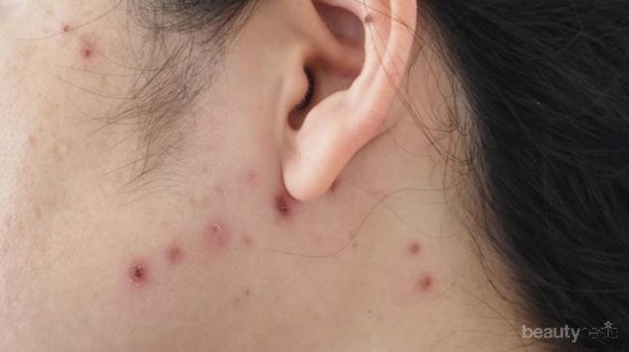 [FORUM] Ada yang tau gimana cara menghilangkan noda hitam bekas cacar??