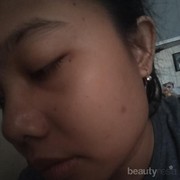 [FORUM] Setelah pemakaian Viva Milk Cleanser-Face tonic Lemon Hari Pertama