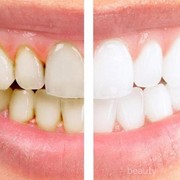 Gak Perlu Aneh-Aneh, Bahan-Bahan Alami Ini Bisa Jadi Cara Menghilangkan Karang Gigi