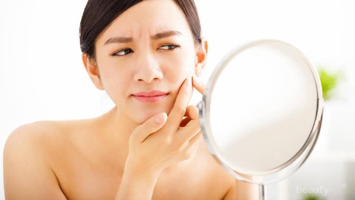 Ssstt, Ini 5 Cara Mengatasi Jerawat Batu yang Pastinya Ampuh Banget!