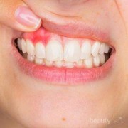 [FORUM] Gusiku gampang banget berdarah, kenapa ya?