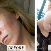 Viral, Wanita Ini Punta Cara Menghilangkan Jerawat dan Bekas Jerawat dengan Sempurna!