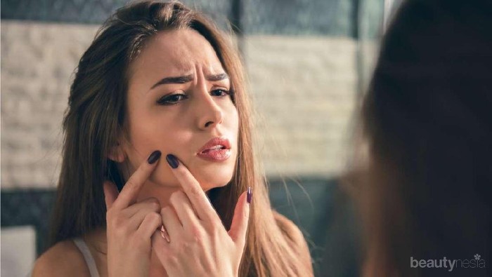 Bahaya Banget! Hindari Memencet Jerawat di Bagian Wajah Ini