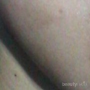 [FORUM] Alergi gara gara pake gel aloe vera!