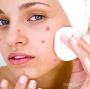 Kulit Wajahmu Berjerawat? Ini Dia Moisturizer yang Tepat Buat kamu!