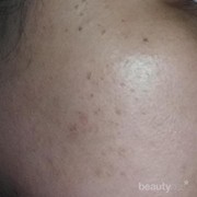 [FORUM] Ada yang pernah berhasil gak ngurangi Flek Hitam? Caranya??