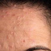 [FORUM] Penyebab kulit beruntusan apa sih?