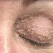 [FORUM] Skin care apa yang ampuh menghilangkan milia pada kulit wajah?