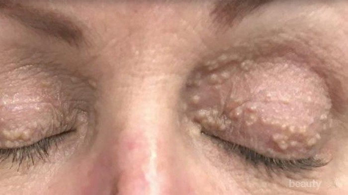 [FORUM] Skin care apa yang ampuh menghilangkan milia pada kulit wajah?