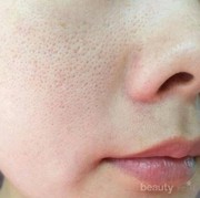 [FORUM] BAGAIMANA SIH CARA MENGATASI PORI PORI BESAR DI WAJAH ?