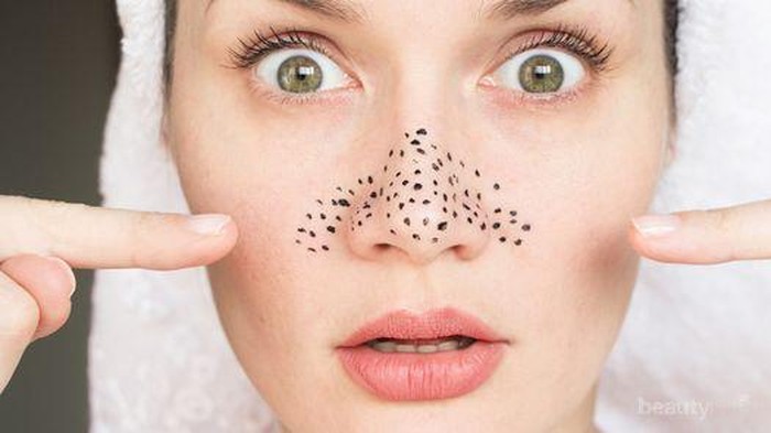 Jangan Anggap Sepele, 5 Hal Ini Bisa Jadi Penyebab Komedo Hitam di Wajah!